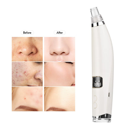Blackhead Comedones Whitehead Pore Vacuum Cleaner Remover with Hot Compress Function with USB Cable for Women Men